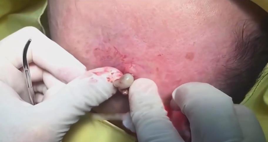 PIMPLE POPPING AND BLACKHEADS - cover