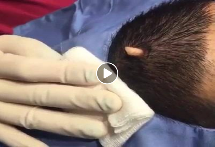 Scalp Sebaceous Cyst | Viral On The Web Now