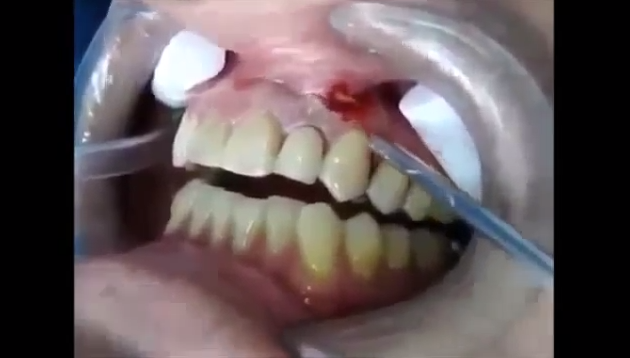 Removing Tonsil Stones With Toothpick