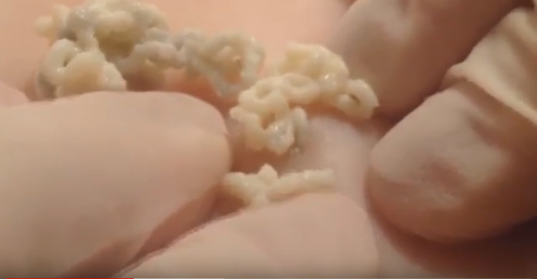 popping hidden tonsil stones