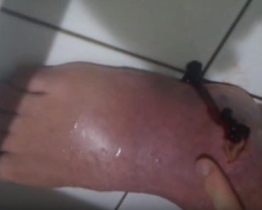 Popping Hematoma In The Foot