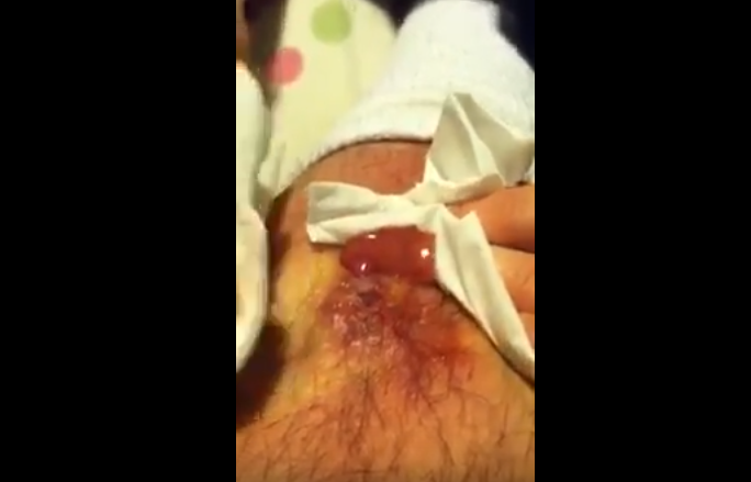 Draining Pus and Blood From Ingrown Hair Leg Infection ...