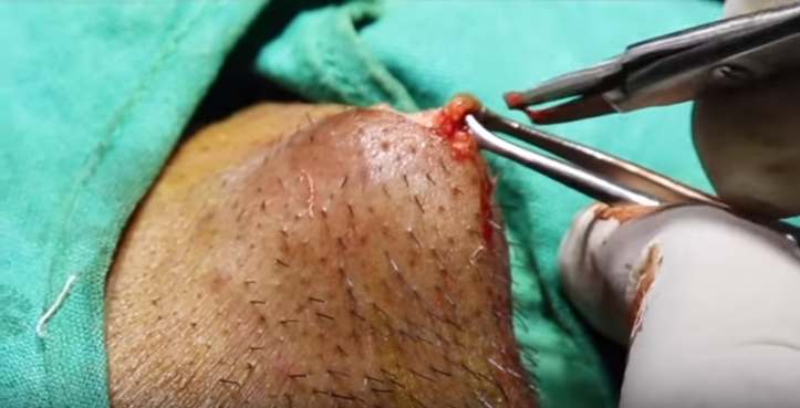 how to remove an epidermoid cyst at home