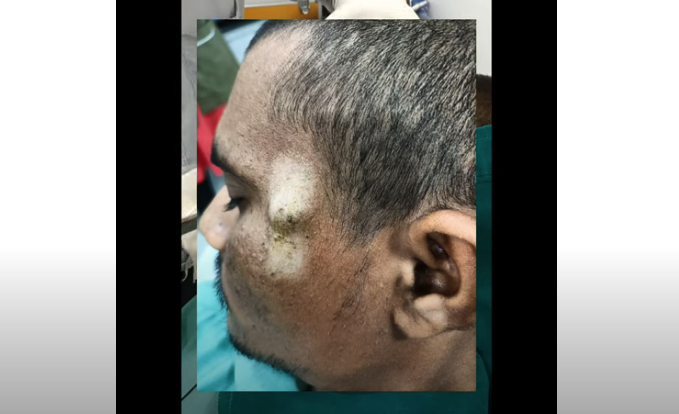 sebaceous-cyst-removal-on-face-pulled-out-viral-on-the-web-now